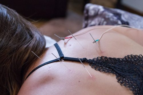 exemple d'utilisation de l'éléctro acupuncture